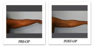 Liposuction - Arms