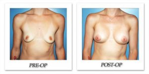 phoca_thumb_l_before-after-017