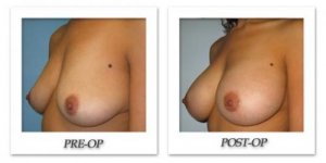 phoca_thumb_l_bruno-breast-augmentation-002
