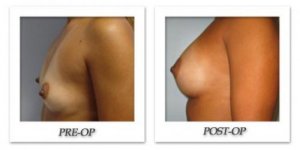 phoca_thumb_l_bruno-breast-augmentation-012