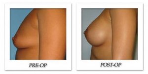 phoca_thumb_l_bruno-breast-augmentation-014