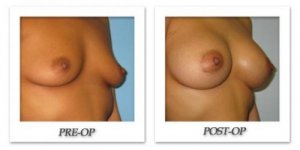 phoca_thumb_l_bruno-breast-augmentation-015