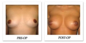 phoca_thumb_l_bruno-breast-augmentation-016