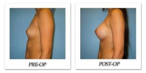 phoca_thumb_l_bruno-breast-augmentation-019