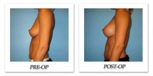 phoca_thumb_l_bruno-breast-augmentation-022