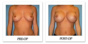 phoca_thumb_l_bruno-breast-augmentation-023