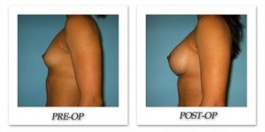 phoca_thumb_l_bruno-breast-augmentation-030