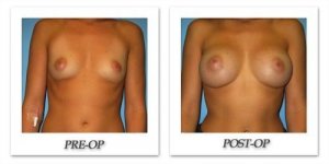 phoca_thumb_l_bruno-breast-augmentation-031