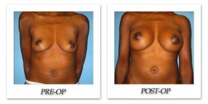 phoca_thumb_l_bruno-breast-augmentation-034