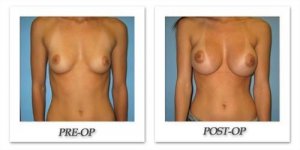 phoca_thumb_l_bruno-breast-augmentation-037