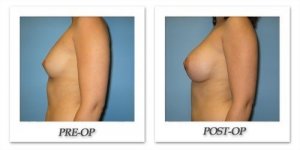 phoca_thumb_l_bruno-breast-augmentation-040