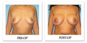 phoca_thumb_l_bruno-breast-augmentation-043