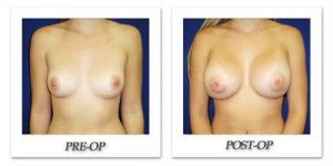 phoca_thumb_l_cohen-breast-augmentation-010