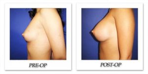 phoca_thumb_l_cohen-breast-augmentation-018