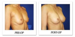 phoca_thumb_l_cohen-breast-augmentation-027