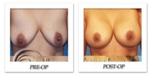 phoca_thumb_l_hodnett-breast-augmentation-003