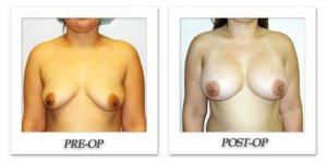 phoca_thumb_l_hodnett-breast-augmentation-018