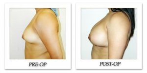 phoca_thumb_l_hodnett-breast-augmentation-021