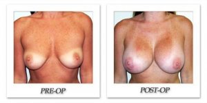 phoca_thumb_l_hodnett-breast-augmentation-025