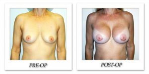 phoca_thumb_l_hodnett-breast-augmentation-027