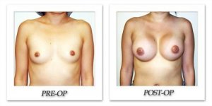 phoca_thumb_l_hodnett-breast-augmentation-032