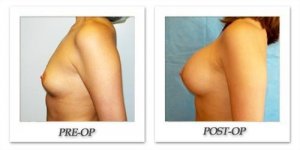 phoca_thumb_l_hodnett-breast-augmentation-035
