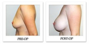 phoca_thumb_l_hodnett-breast-augmentation-038