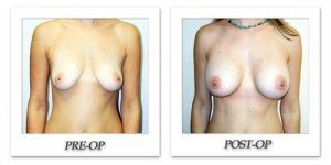 phoca_thumb_l_hodnett-breast-augmentation-042