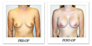 phoca_thumb_l_hodnett-breast-augmentation-044