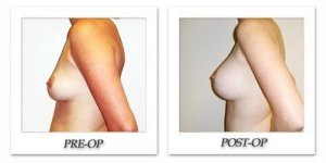 phoca_thumb_l_hodnett-breast-augmentation-048