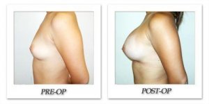 phoca_thumb_l_hodnett-breast-augmentation-051