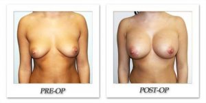 phoca_thumb_l_hodnett-breast-augmentation-056
