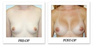 phoca_thumb_l_hodnett-breast-augmentation-patient6-front