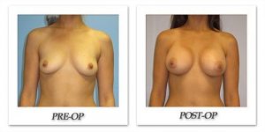 phoca_thumb_l_hsu-breast-augmentation-001