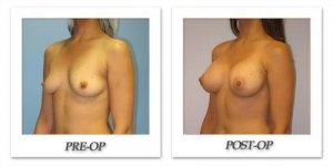 phoca_thumb_l_hsu-breast-augmentation-002