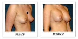 phoca_thumb_l_hsu-breast-augmentation-009