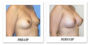 phoca_thumb_l_mandris-breast-augmentation-004