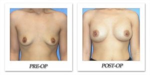 phoca_thumb_l_mandris-breast-augmentation-005