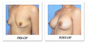 phoca_thumb_l_mandris-breast-augmentation-006