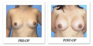 phoca_thumb_l_mandris-breast-augmentation-007