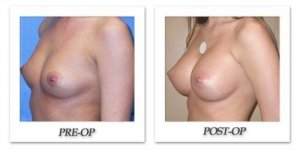 phoca_thumb_l_mandris-breast-augmentation-016