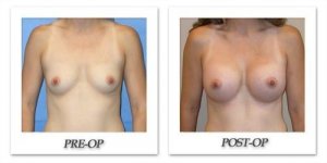 phoca_thumb_l_mandris-breast-augmentation-017