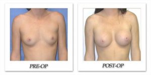 phoca_thumb_l_mandris-breast-augmentation-025