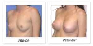 phoca_thumb_l_mandris-breast-augmentation-026