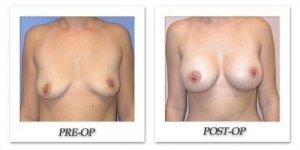 phoca_thumb_l_mandris-breast-augmentation-029
