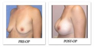 phoca_thumb_l_mandris-breast-augmentation-030