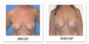 phoca_thumb_l_mandris-breast-augmentation-031