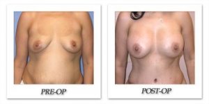 phoca_thumb_l_mandris-breast-augmentation-041