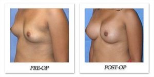 phoca_thumb_l_mandris-breast-augmentation-046