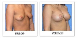 phoca_thumb_l_mandris-breast-augmentation-048